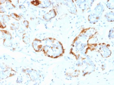 Formalin-fixed, paraffin-embedded human Breast stained with Crystallin Alpha B Mouse Monoclonal Antibody (CPTC-CYRAB-1).