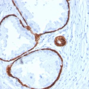 Formalin-fixed, paraffin-embedded human Prostate Carcinoma stained with Cytokeratin 14 Mouse Monoclonal Antibody (KRT14/2375).