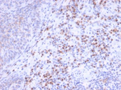 Formalin-fixed, paraffin-embedded human Unknown Tumor stained with RCAS1 Mouse Monoclonal Antibody (CPTC-EBAG9-1).