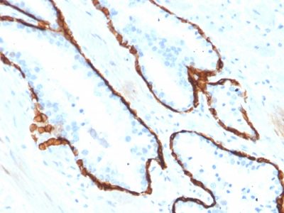 Formalin-fixed, paraffin-embedded human Prostate Carcinoma stained with Cytokeratin 15 Mouse Monoclonal Antibody (KRT15/2554).