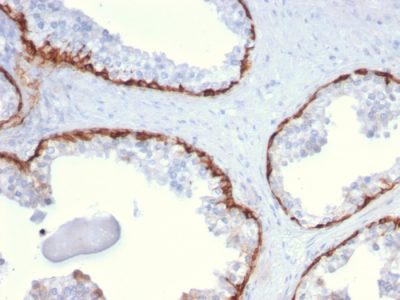 Formalin-fixed, paraffin-embedded human Prostate Carcinoma stained with Cytokeratin 15 Mouse Monoclonal Antibody (KRT15/2959)