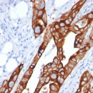 Formalin-fixed, paraffin-embedded human Colon Carcinoma stained with Cytokeratin 20 (KRT20) Mouse Monoclonal Antibody (KRT20/1991).