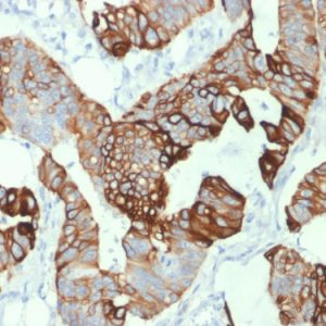 Formalin-fixed, paraffin-embedded human Colon Carcinoma stained with Cytokeratin 20 (KRT20) Mouse Monoclonal Antibody (KRT20/1993).