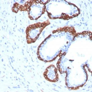 Formalin-fixed, paraffin-embedded human Prostate Carcinoma stained with Cytokeratin 5 Mouse Monoclonal Antibody (KRT5/3594).