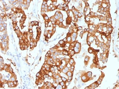 Formalin-fixed, paraffin-embedded human Ovarian Carcinoma stained with Cytokeratin-7 Mouse Monoclonal Antibody (KRT7/2200).