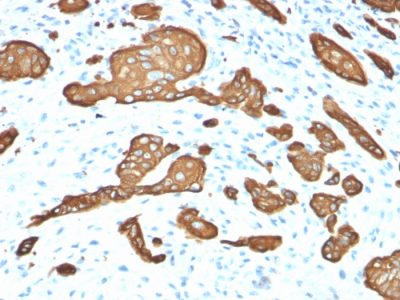 Formalin-fixed, paraffin-embedded human Skin Basal Cell Carcinoma stained with Cytokeratin 8 Mouse Monoclonal Antibody (KRT8/2115).