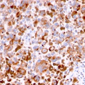 Formalin-fixed, paraffin-embedded human Melanoma stained with CD63 Mouse Monoclonal Antibody (LAMP3/2788).