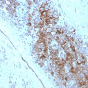 Formalin-fixed, paraffin-embedded human Melanoma stained with CD63 Mouse Monoclonal Antibody (LAMP3/2789).