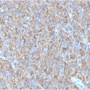Formalin-fixed, paraffin-embedded human Melanoma stained with CD63 Mouse Monoclonal Antibody (LAMP3/2790)