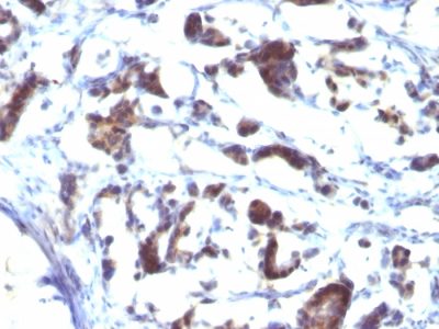 Formalin-fixed, paraffin-embedded human Gastric Carcinoma stained with ZFYVE28 Mouse Monoclonal Antibody (LST2/2426)