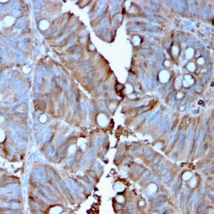 Formalin-fixed, paraffin-embedded human Colon Carcinoma stained with MerTK Mouse Monoclonal Antibody (MERTK/3015).