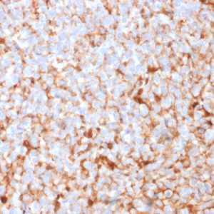 Formalin-fixed, paraffin-embedded human Breast Carcinoma stained with Mammaglobin Recombinant Rabbit Monoclonal Antibody (MGB1/2682R).