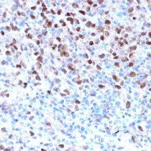 Formalin-fixed, paraffin-embedded human Melanoma stained with MITF Recombinant Rabbit Monoclonal Antibody (MITF/2987R).