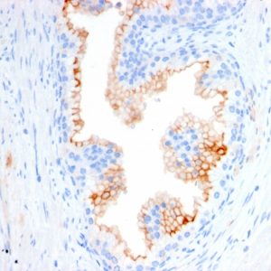 Formalin-fixed, paraffin-embedded human Prostate Carcinoma stained with CD10 Mouse Monoclonal Antibody (MME/2580).