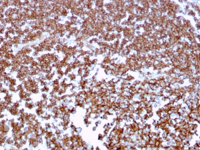 Formalin-fixed, paraffin-embedded human Tonsil stained with CD20 Mouse Monoclonal Antibody (MS4A1/3409).