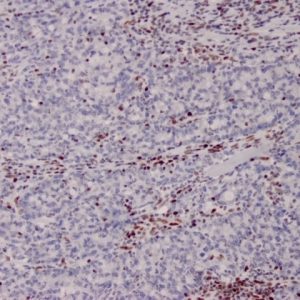 Formalin-fixed, paraffin-embedded human Colon Carcinoma stained with MSH2 Mouse Monoclonal Antibody (MSH2/2622).