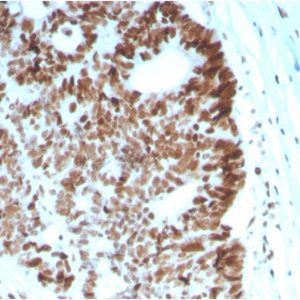 Formalin-fixed, paraffin-embedded human Colon Carcinoma stained with MSH6 Mouse Monoclonal Antibody (MSH6/2927).