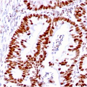 Formalin-fixed, paraffin-embedded human Colon Carcinoma stained with MSH6 Mouse Monoclonal Antibody (MSH6/3085).
