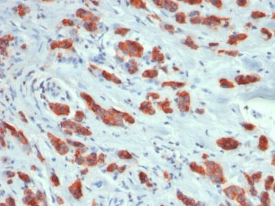 Formalin-fixed, paraffin-embedded human Breast Carcinoma stained with MUC1 Rabbit Recombinant Monoclonal Antibody (MUC1/1887R).