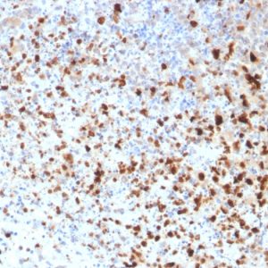 Formalin-fixed, paraffin-embedded human Cervix stained with HSV1 Mouse Monoclonal Antibody (10A3).