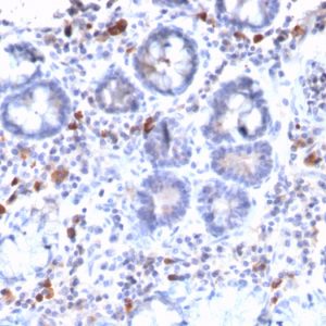 Formalin-fixed, paraffin-embedded human Gastric Carcinoma stained with MUC3 Rabbit Recombinant Monoclonal Antibody (MUC3/2992R).