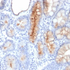 Formalin-fixed, paraffin-embedded human Gastric Carcinoma stained with MUC4 Mouse Monoclonal Antibody (MUC4/3084).