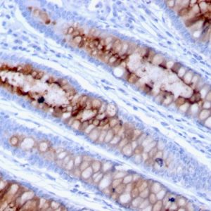 Formalin-fixed, paraffin-embedded human Colon Carcinoma stained with MUC4 Mouse Monoclonal Antibody (MUC4/3105).