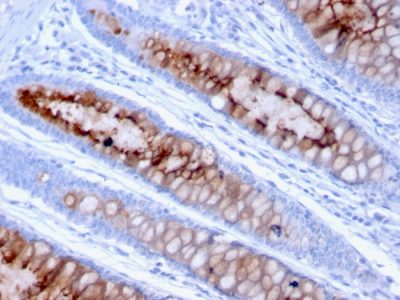 Formalin-fixed, paraffin-embedded human Colon Carcinoma stained with MUC4 Mouse Monoclonal Antibody (MUC4/3105).