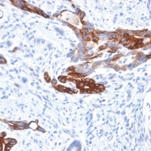 Formalin-fixed, paraffin-embedded human Gastric Carcinoma stained with MUC6 Rabbit Recombinant Monoclonal Antibody (MUC6/1553R).