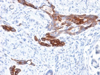 Formalin-fixed, paraffin-embedded human Gastric Carcinoma stained with MUC6 Rabbit Recombinant Monoclonal Antibody (MUC6/1553R).