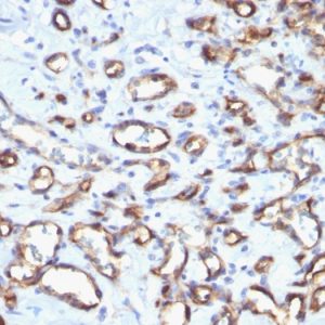 Formalin-fixed, paraffin-embedded human Angiosarcoma stained with CD34 Rabbit Polyclonal Antibody.