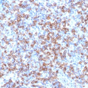 Formalin-fixed, paraffin-embedded human Lymphoma stained with CD8a Rabbit Polyclonal Antibody.