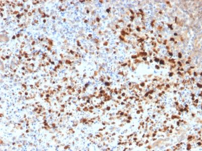 Formalin-fixed, paraffin-embedded human Cervix stained with HSV1 Rabbit Polyclonal Antibody.