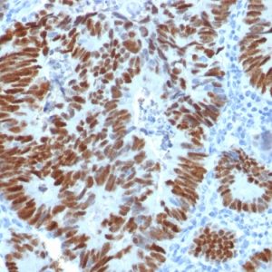 Formalin-fixed, paraffin-embedded human Colon Carcinoma stained with p53 Rabbit Polyclonal Antibody.
