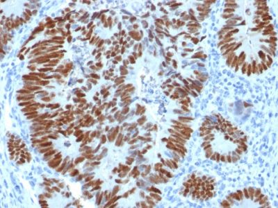 Formalin-fixed, paraffin-embedded human Colon Carcinoma stained with p53 Rabbit Polyclonal Antibody.