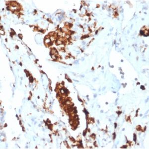 Formalin-fixed, paraffin-embedded human Lung Adenocarcinoma stained with Napsin A Rabbit Recombinant Monoclonal Antibody (NAPSA/1865R).