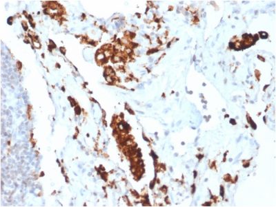 Formalin-fixed, paraffin-embedded human Lung Adenocarcinoma stained with Napsin A Rabbit Recombinant Monoclonal Antibody (NAPSA/1865R).