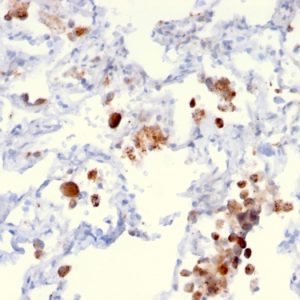 Formalin-fixed, paraffin-embedded human Lung Adenocarcinoma stained with Napsin A Mouse Monoclonal Antibody (NAPSA/3306).