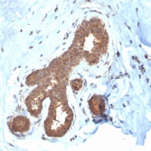 Formalin-fixed, paraffin-embedded human Breast Carcinoma stained with GSTMu2 Mouse Monoclonal Antibody (CPTC-GSTMu2-2).