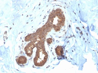 Formalin-fixed, paraffin-embedded human Breast Carcinoma stained with GSTMu2 Mouse Monoclonal Antibody (CPTC-GSTMu2-2).