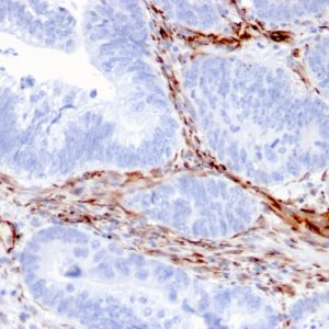 Formalin-fixed, paraffin-embedded human Colon Carcinoma stained with Nestin Mouse Monoclonal Antibody (NES/2911).