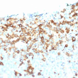 Formalin-fixed, paraffin-embedded human Melanoma stained with NGFR Mouse Monoclonal Antibody (NGFR/1964).