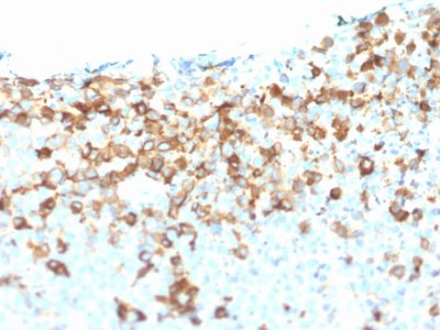 Formalin-fixed, paraffin-embedded human Melanoma stained with NGFR Mouse Monoclonal Antibody (NGFR/1964).