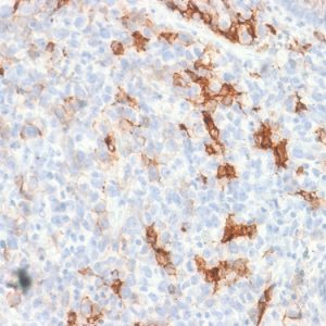 Formalin-fixed, paraffin-embedded human Melanoma stained with NGFR Rabbit Recombinant Monoclonal Antibody (NGFR/1997R).
