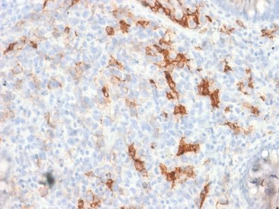 Formalin-fixed, paraffin-embedded human Melanoma stained with NGFR Rabbit Recombinant Monoclonal Antibody (NGFR/1997R).