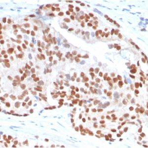 Formalin-fixed, paraffin-embedded human Prostate Carcinoma stained with NKX3.1-Monospecific Mouse Monoclonal Antibody (NKX3.1/3347).