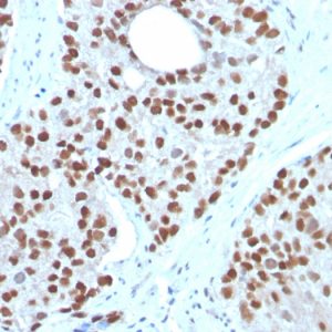 Formalin-fixed, paraffin-embedded human Prostate Carcinoma stained with NKX3.1 Mouse Monoclonal Antibody (NKX3.1/3350).