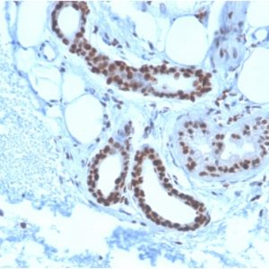 Formalin-fixed, paraffin-embedded human Basal Cell Carcinoma stained with Nucleophosmin-Monospecific Mouse Monoclonal Antibody (NPM1/3285).