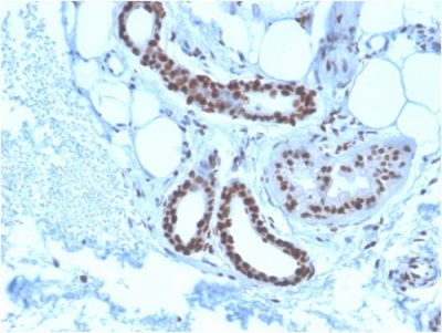 Formalin-fixed, paraffin-embedded human Basal Cell Carcinoma stained with Nucleophosmin-Monospecific Mouse Monoclonal Antibody (NPM1/3285).