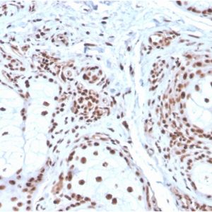 Formalin-fixed, paraffin-embedded human Basal Cell Carcinoma stained with Nucleophosmin Mouse Monoclonal Antibody (NPM1/3286).